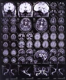 Brain Injury